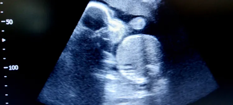 Płód w 18 tygodniu widoczny na zdjęciu ultrasonograficznym