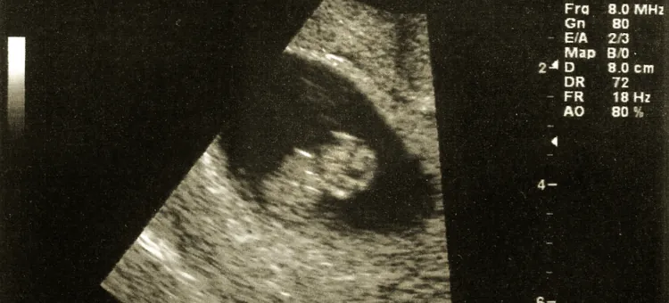 Obraz USG płodu w 8. tygodniu ciąży