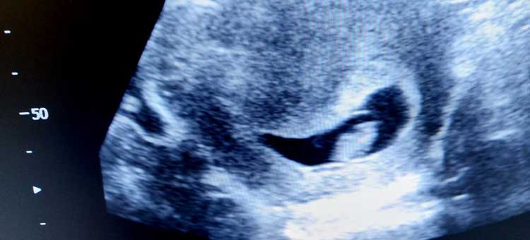 wizualizacja USG płodu w 7 tygodniu ciąży