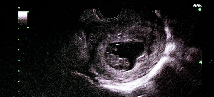 Obraz USG płodu w 9. tygodniu ciąży