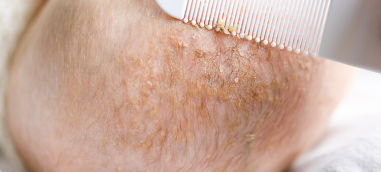 Ciemieniucha u niemowlęcia – łuszcząca się skóra głowy usuwana delikatnym grzebieniem