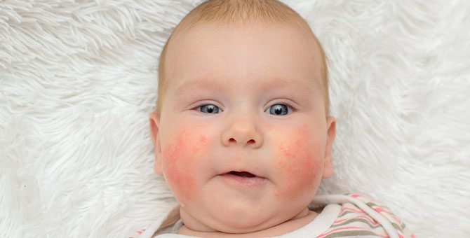 alergie u małego dziecka