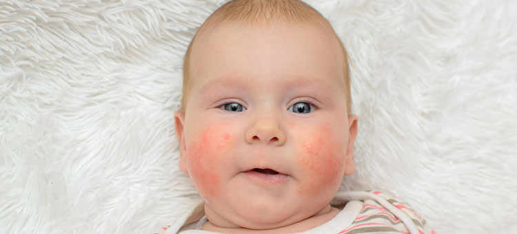 alergie u małego dziecka