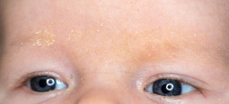 Ciemieniucha u niemowlęcia widoczna na czole i w okolicy brwi