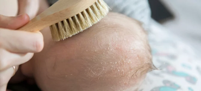 Pielęgnacja skóry głowy niemowlęcia z ciemieniuchą przy użyciu miękkiej szczotki