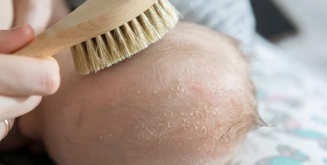 Pielęgnacja skóry głowy niemowlęcia z ciemieniuchą przy użyciu miękkiej szczotki
