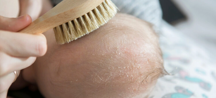 Pielęgnacja skóry głowy niemowlęcia z ciemieniuchą przy użyciu miękkiej szczotki