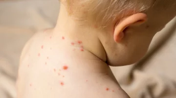 Dziecko z czerwoną wysypką na plecach i karku