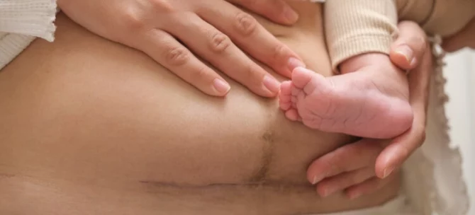 Mama z dzieckiem na rękach pokazująca bliznę po cesarskim cięciu na brzuchu