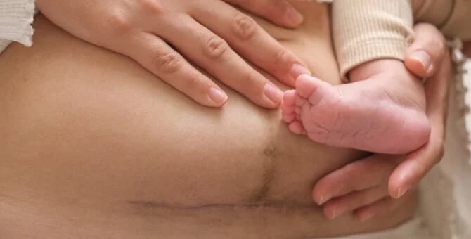 Mama z dzieckiem na rękach pokazująca bliznę po cesarskim cięciu na brzuchu