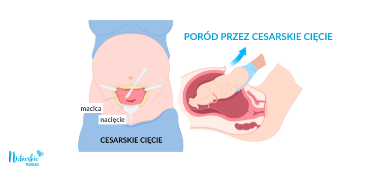 Infografika przedstawiająca operację cesarskiego cięcia