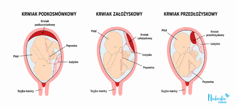 Diagnostyka krwiaka podkosmówkowego Infografika przedstawiająca krwiak podkosmówkowy, założyskowy i przedłożyskowy