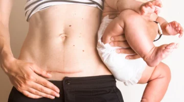 Mama z blizną po cesarskim cięciu z dzieckiem na rękach