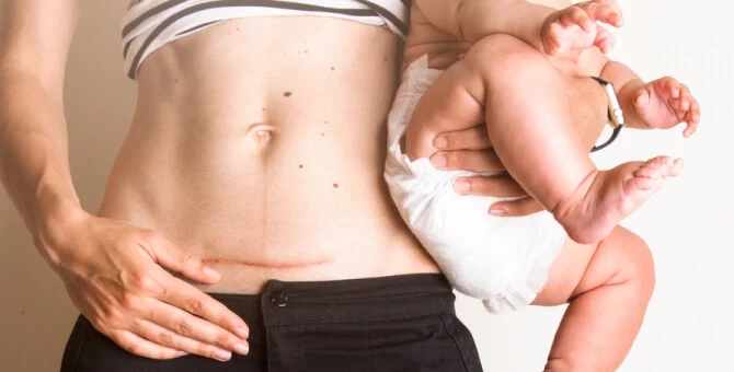 Mama z blizną po cesarskim cięciu z dzieckiem na rękach