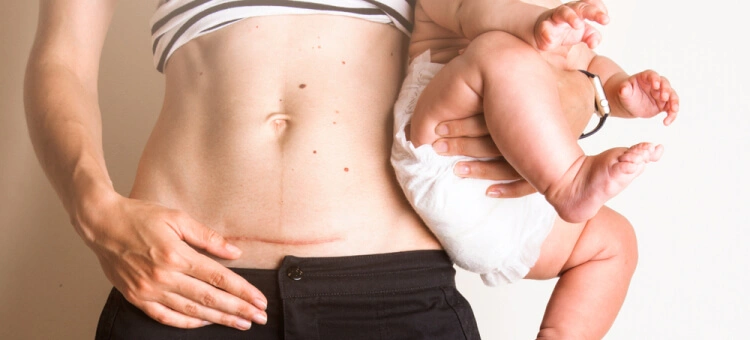 Mama z blizną po cesarskim cięciu z dzieckiem na rękach