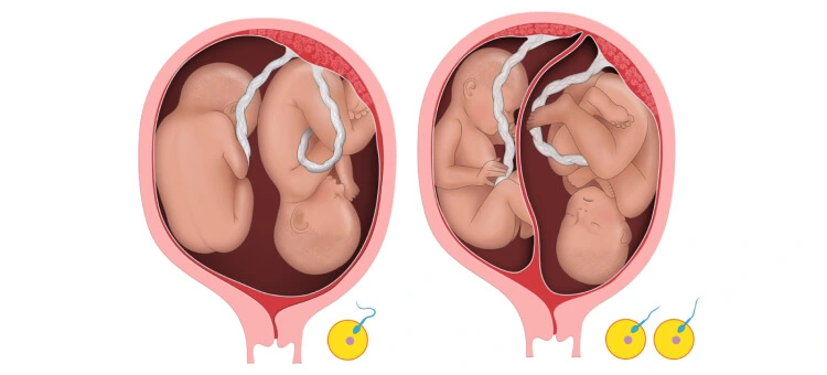 Różnice pomiędzy ciążą bliźniaczą jednojajową a dwujajową