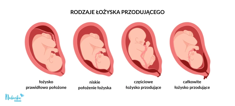 Infografika przedstawiająca rodzaje łożyska przodującego: prawidłowe, niskie, częściowe oraz całkowite