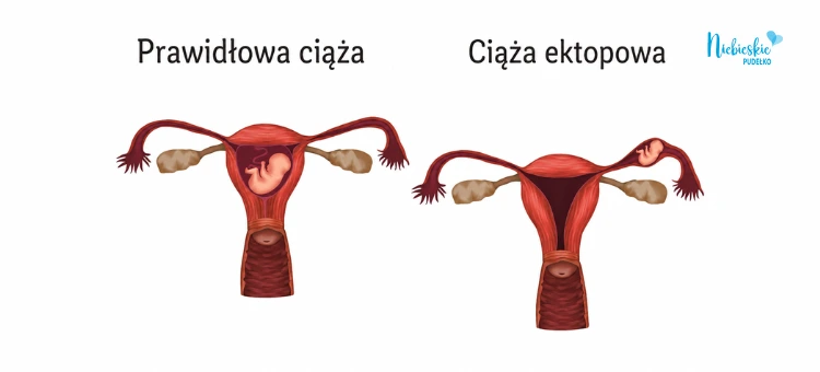 Przyczyny ciąży pozamacicznej – czynniki ryzyka Porównanie prawidłowej ciąży i ciąży pozamacicznej w jajowodzie