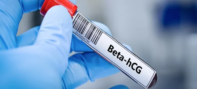 Probówka z próbką krwi do badania beta hCG wykrywającego wczesną ciążę