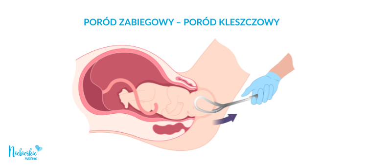 Infografika przedstawiająca poród zabiegowy kleszczowy