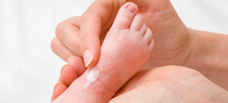 stopa niemowlęcia ze skazą białkową