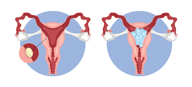 Schemat medyczny macicy pokazujący zaśniad groniasty i zmiany w jamie macicy