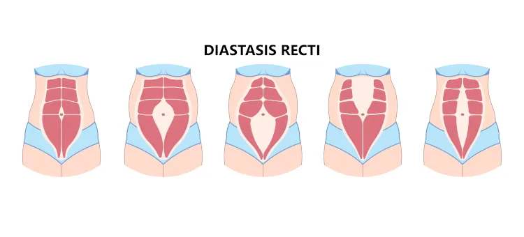 Diastasis recti, separacja mięśni brzucha po porodzie, schematy