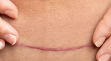 Rozchodząca się blizna po cesarskim cięciu na brzuchu