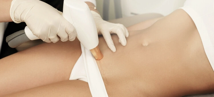 Laseroterapia IPL na bliznę po cesarskim cięciu