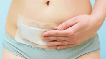 Gojenie się blizny po cesarskim cięciu
