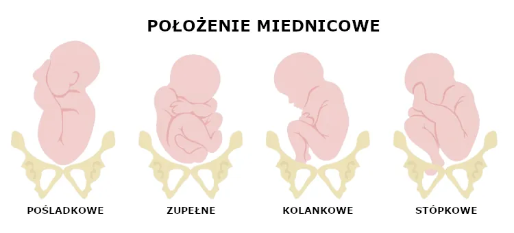 Różne warianty ułożenia płodu przy położeniu miednicowym
