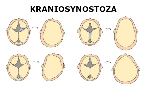 Ilustracja wpływu zespolenia czaszkowych szwów na kształt głowy w przypadku kraniosynostozy