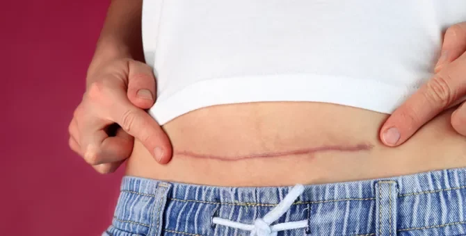 Dłoń delikatnie obejmująca widoczny ślad po zabiegu cesarskiego cięcia na skórze brzucha