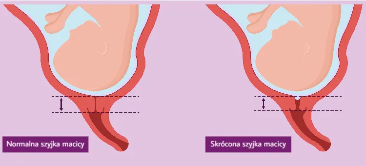 Diagnostyka – jak rozpoznać niewydolność szyjki macicy? Porównanie prawidłowej i skróconej szyjki macicy u ciężarnej przedstawione na jasnofioletowym tle