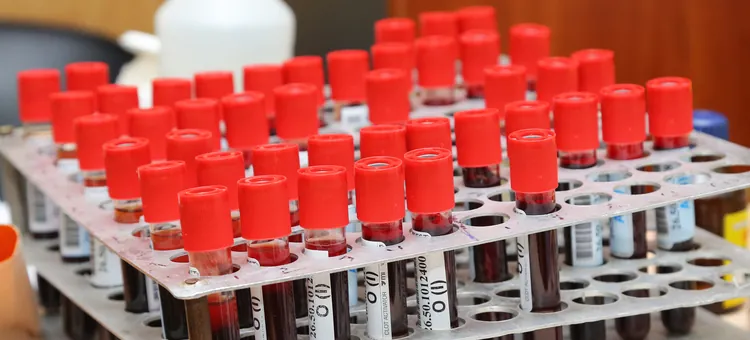 Medyczne fiolki z czerwonymi zatyczkami wypełnione ciemnym płynem ustrojowym umieszczone na srebrnej, metalowej podstawce
